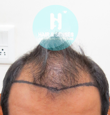 Hairline Designing 3096